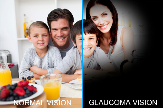 Glaucoma1