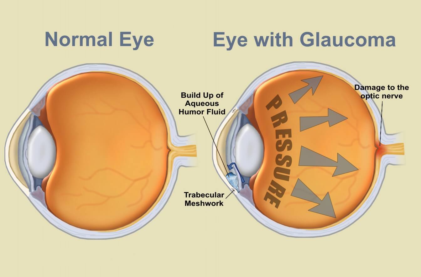 Glaucoma2 (1)